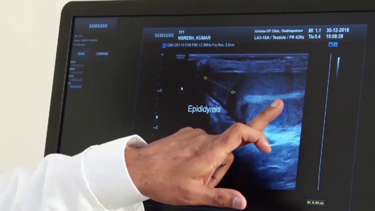 Testicular Ultrasound Scan